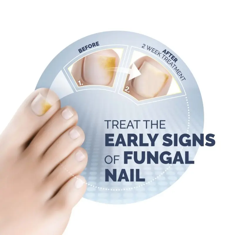 Scholl Fungal Nail Treatment
