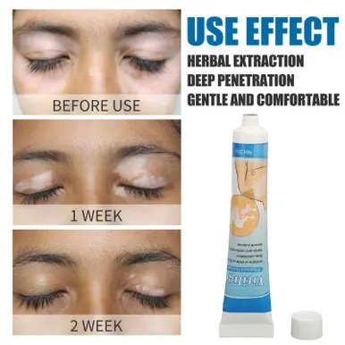 Vitiligo Cream Herbal Extract White Spots Vitiligo Treatment Ointment OMC